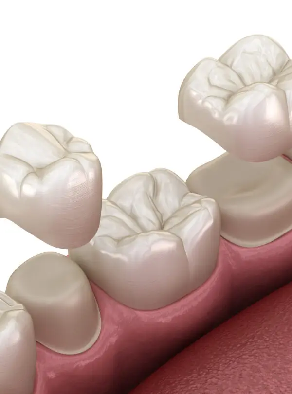 Porcelain crowns placement over premolar and molar teeth. . Medically accurate 3D illustration