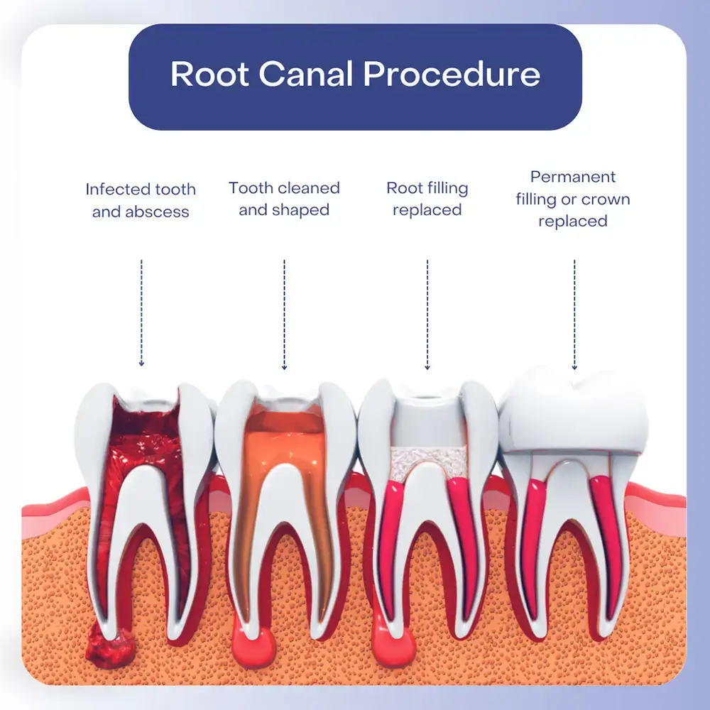 image explaining root canal procedure