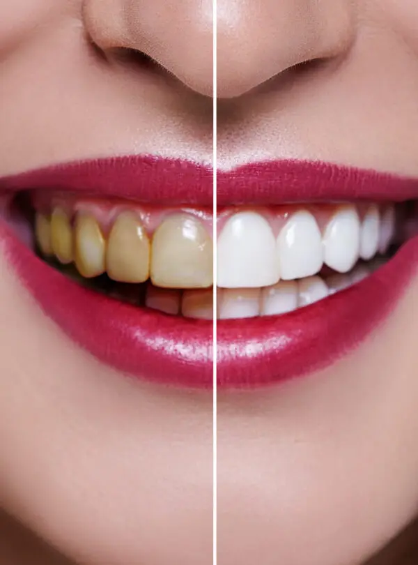 Woman Teeth before and after dental treatment. Teeth Whitening. Happy smiling woman. Dental health Concept. Oral Care, teeth restoration. Bad teeth.