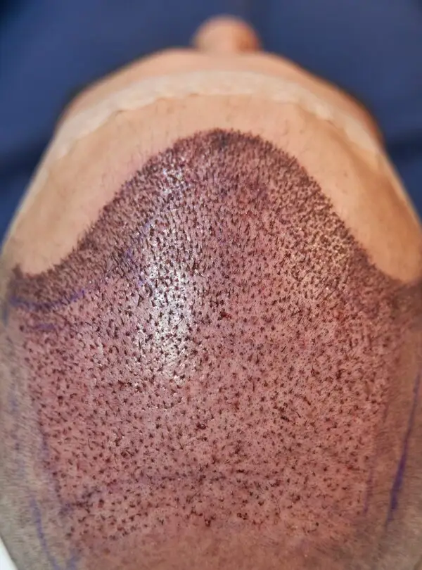 FUE-hair-transplant-square