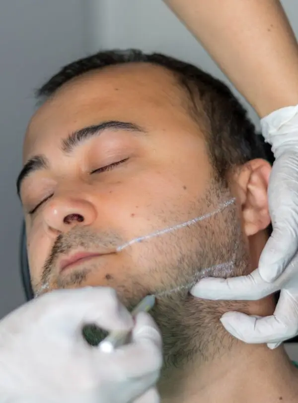 beard-transplant-square