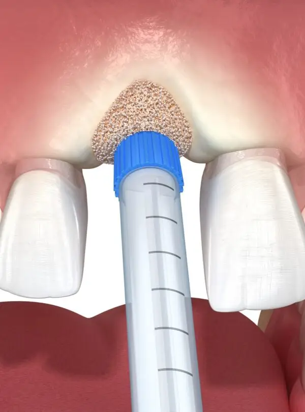 bone-grafting-square