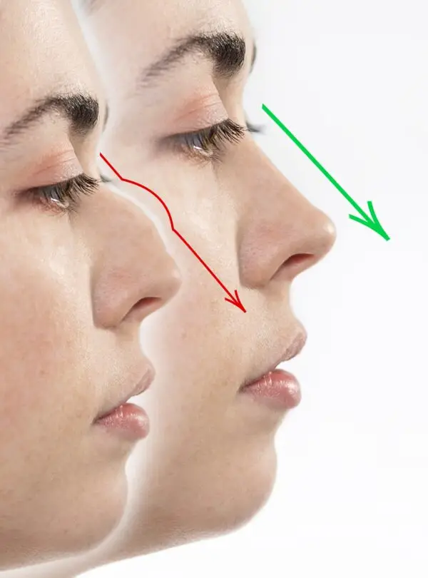 rhinoplasty-square-2