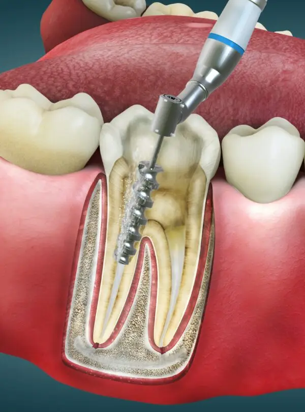 root-canal-square