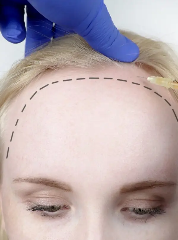 women-hair-transplant-square